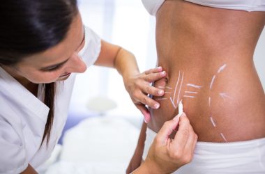 Close-up of surgeon drawing lines on womans abdomen for liposuction Medicaroute-Liposuction