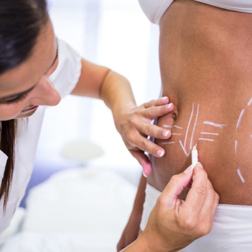 Close-up of surgeon drawing lines on womans abdomen for liposuction Medicaroute-Liposuction