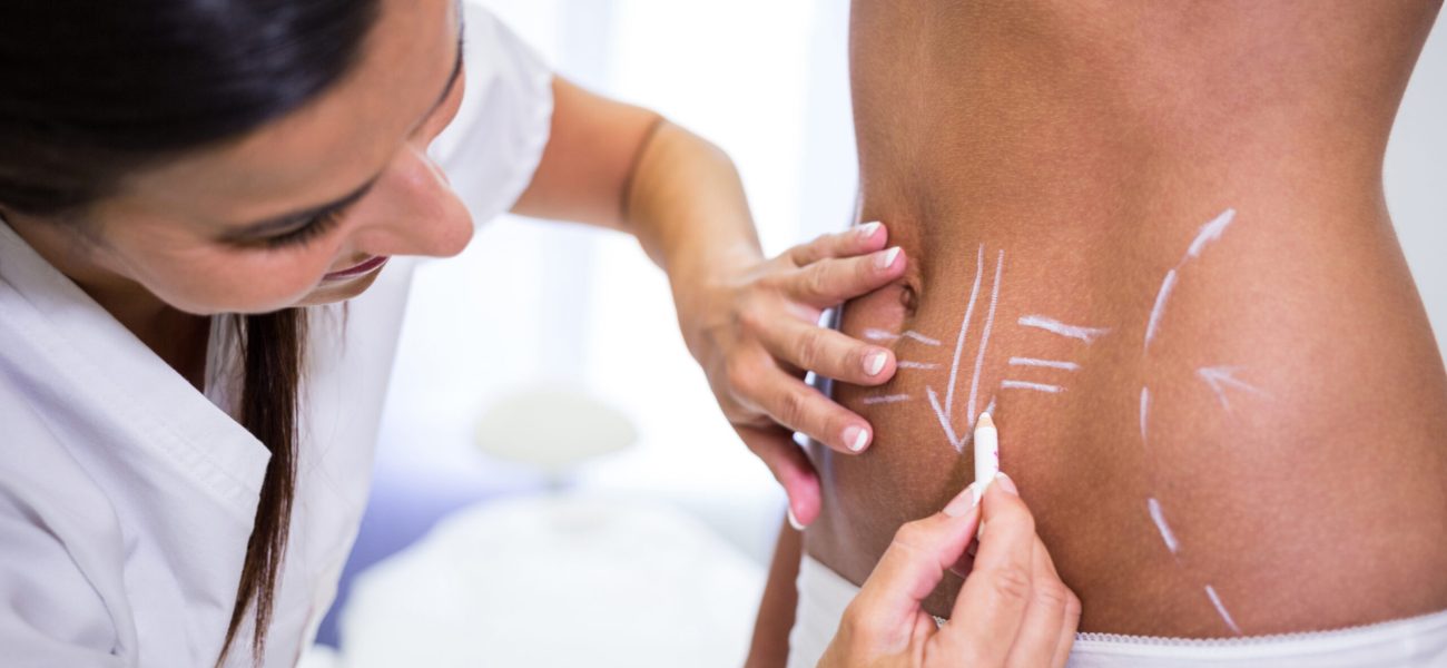 Close-up of surgeon drawing lines on womans abdomen for liposuction Medicaroute-Liposuction