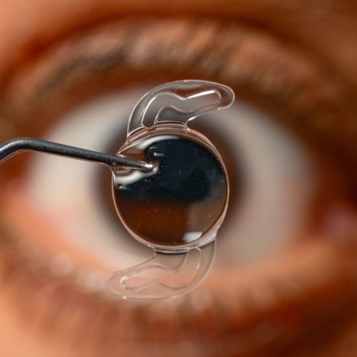 Medicaroute-cataract-surgery