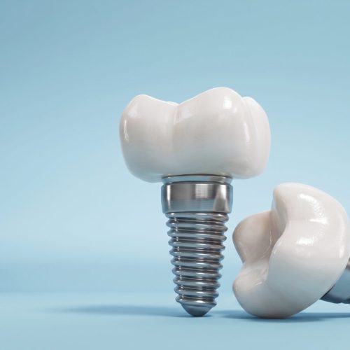 Medicaroute-dental implant