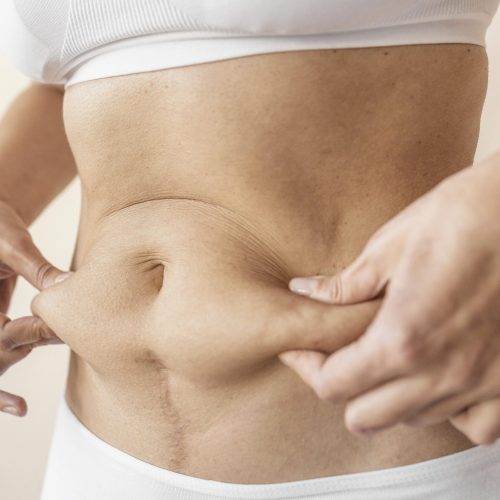 Medicaroute-tummy tuck