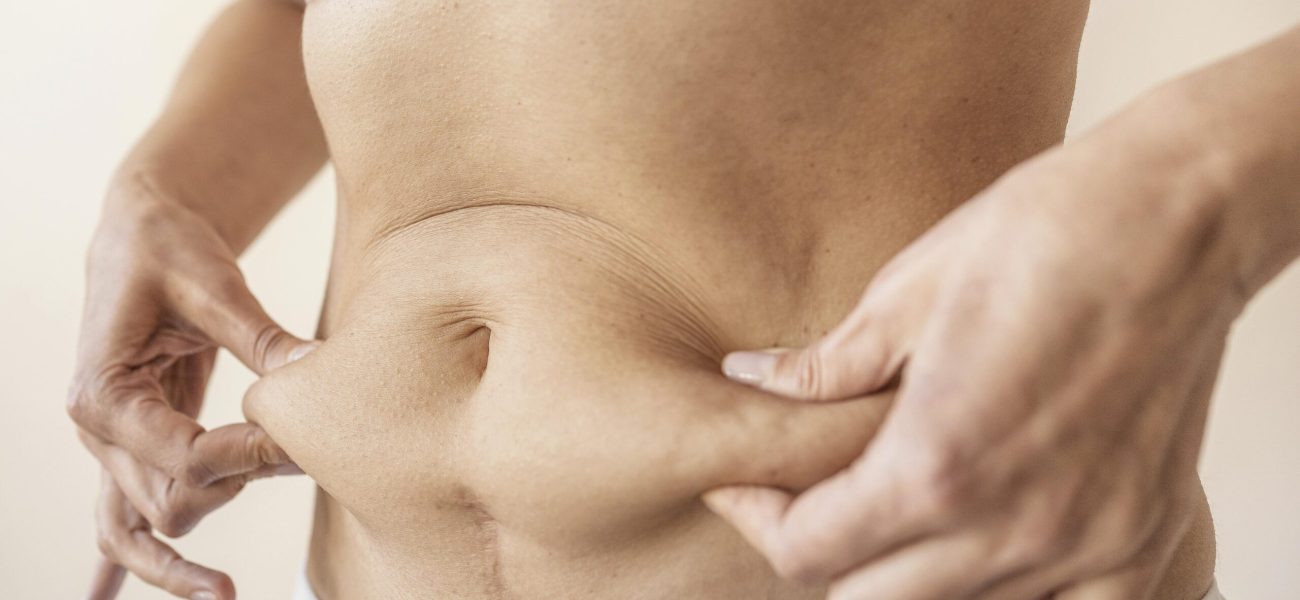 Medicaroute-tummy tuck