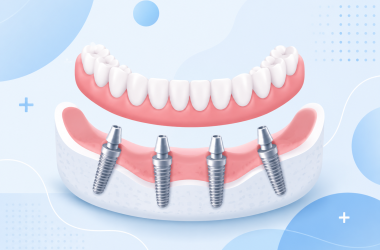 all-on-4 dental implants medicaroute