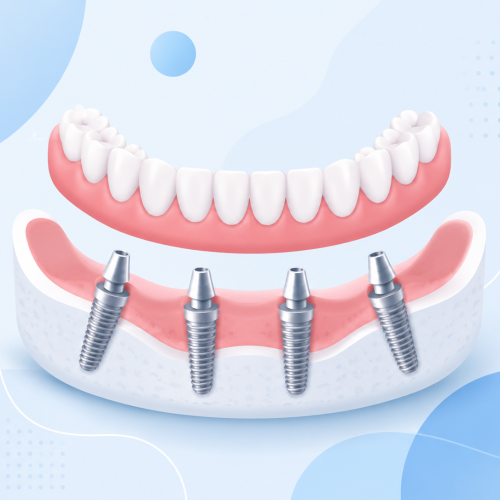 all-on-4 dental implants medicaroute