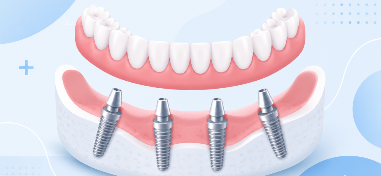 all-on-4 dental implants medicaroute