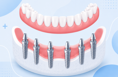 all-on-6-implant-medicaroute