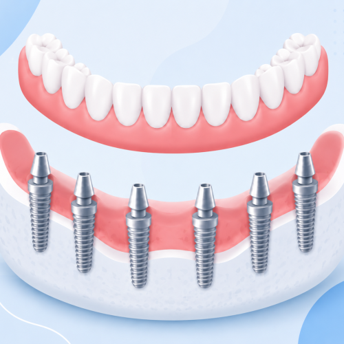 all-on-6-implant-medicaroute