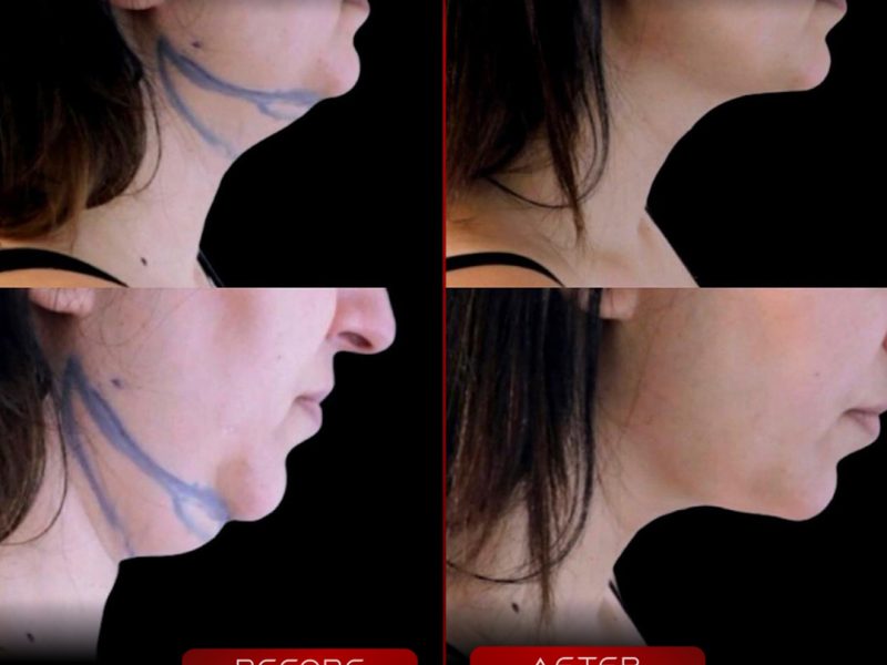 gidi-liposuction-18.09.2025-2