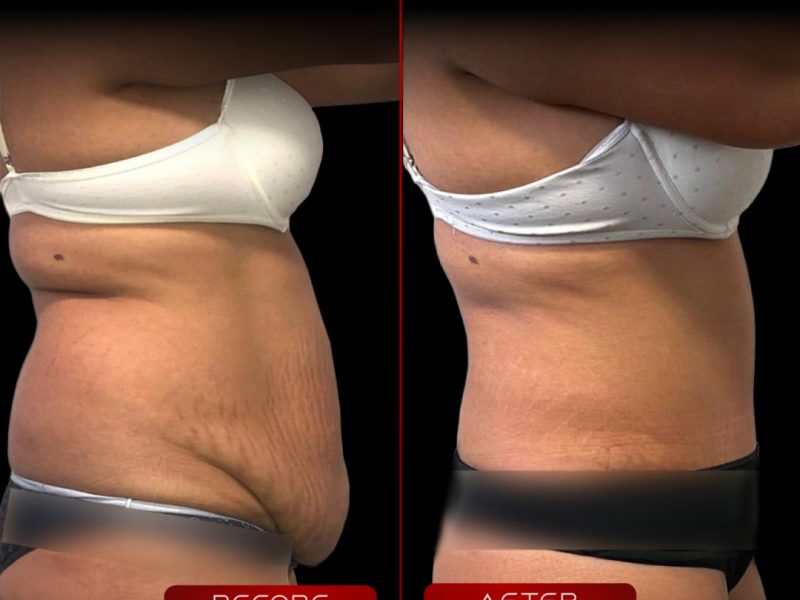 karin-germe-ve-liposuction-12.12-2