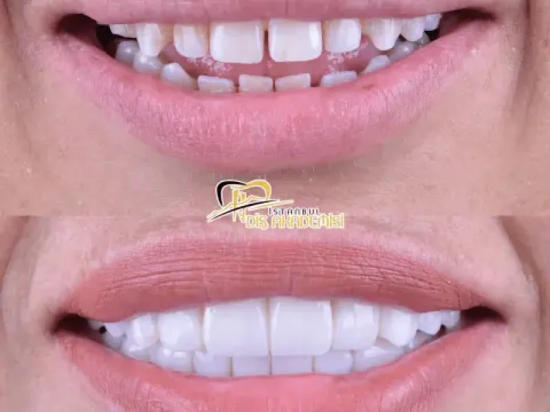 leyla-kanat-oral-before-after-(1)