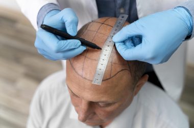 medicaroute-Hair Transplant