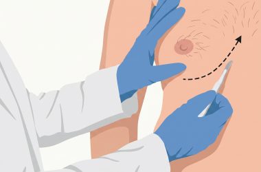 medicaroute-gynecomastia3