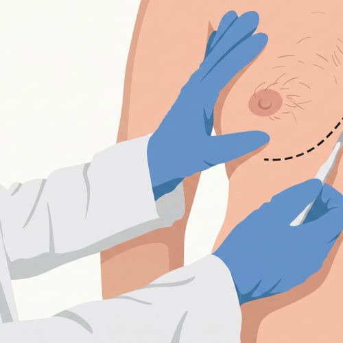medicaroute-gynecomastia3