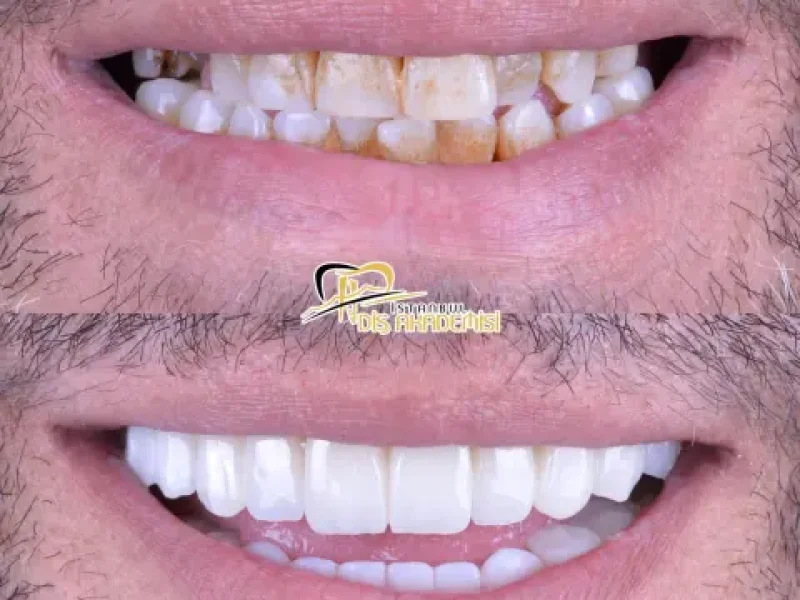 onay-yildiz-oral-before-after-(1)-min
