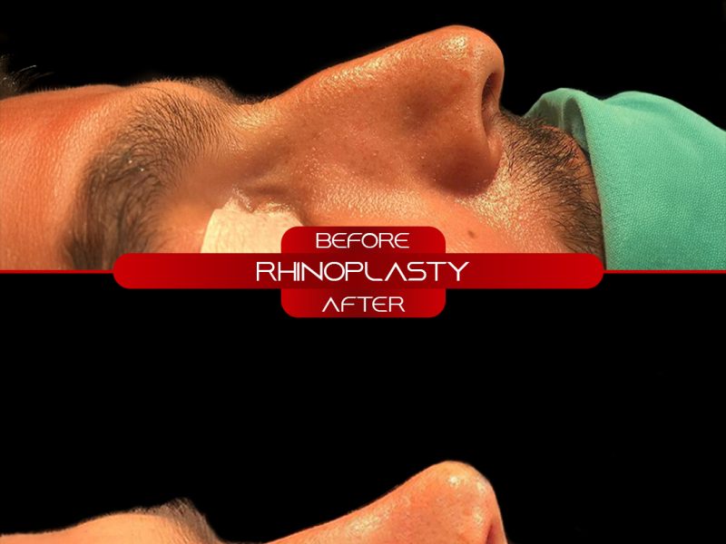 rino-before-after-17.10.2025-4
