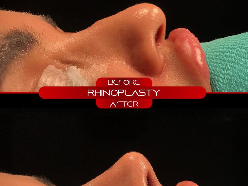 rino-before-after-28.10.2025-4
